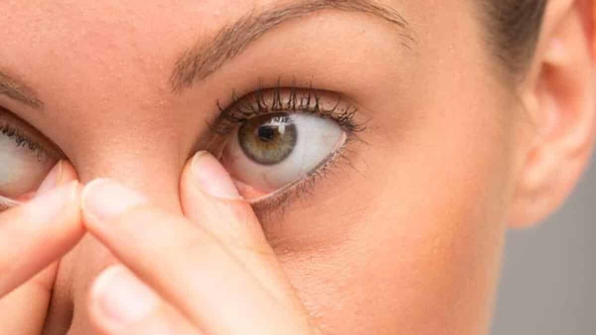 Keratokonusa biyolojik halka nakli tedavisi