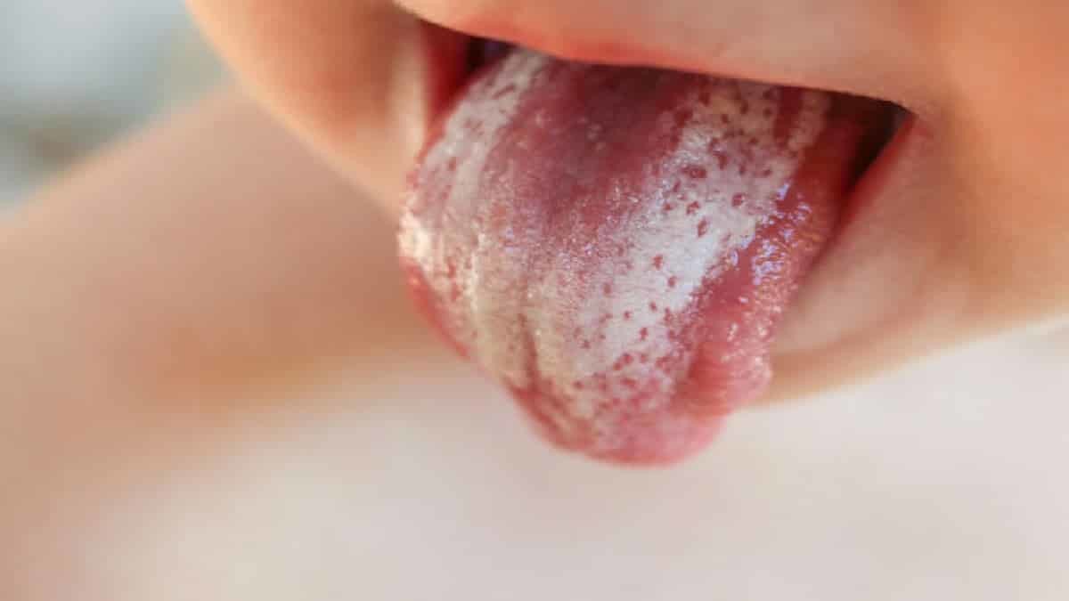 Pamukçuklar en çok yenidoğanlarda görülür