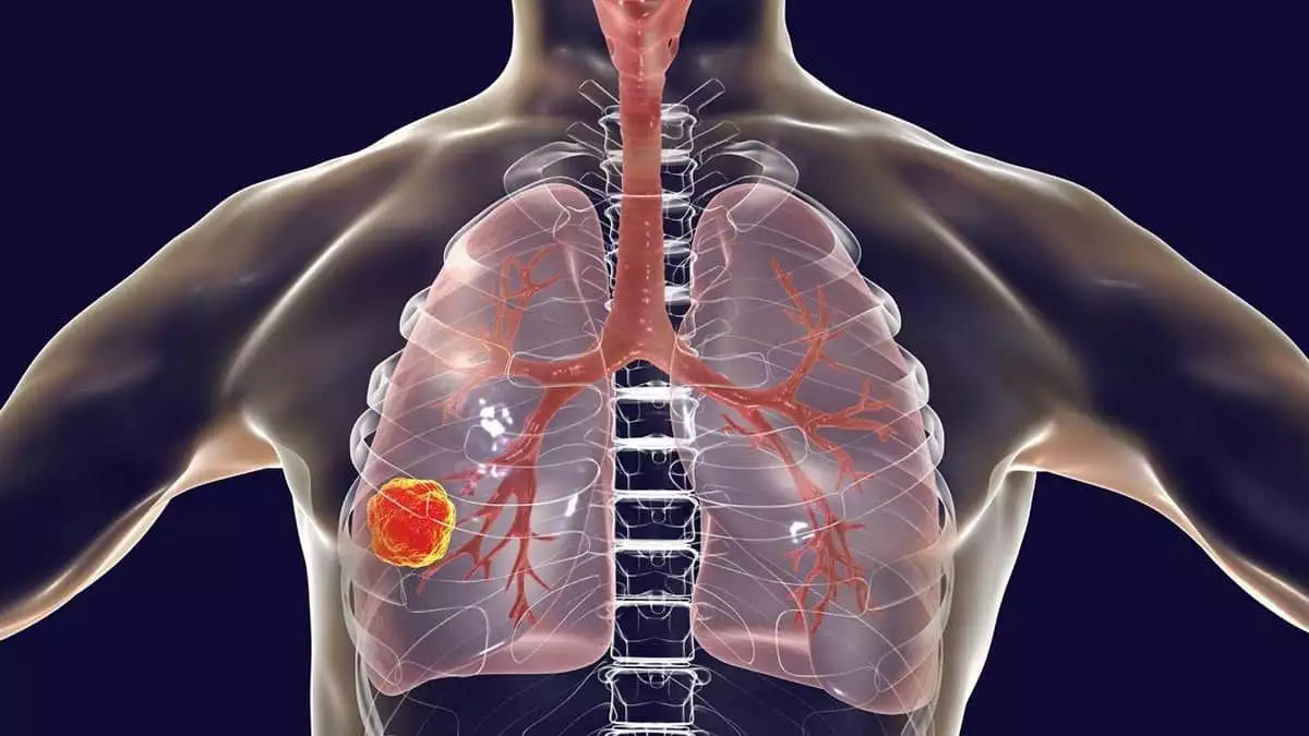 Akciğer kanserinde görülen en sık belirti öksürük