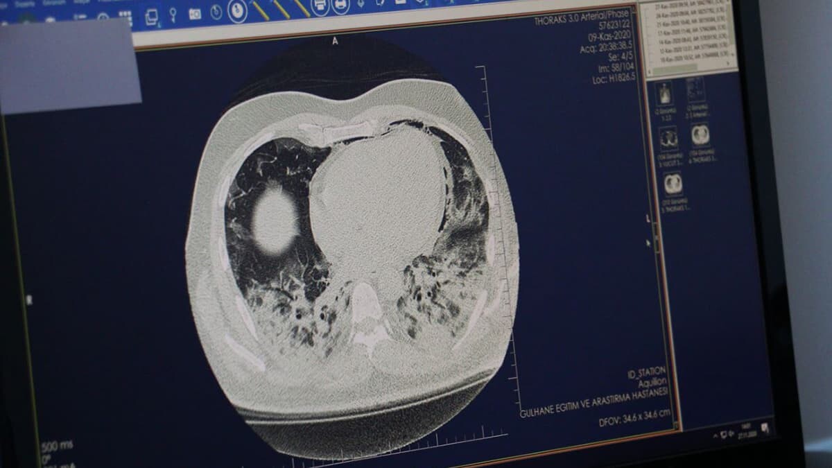 Akciğerdeki solunum keseciklerinde hasara yol açıyor
