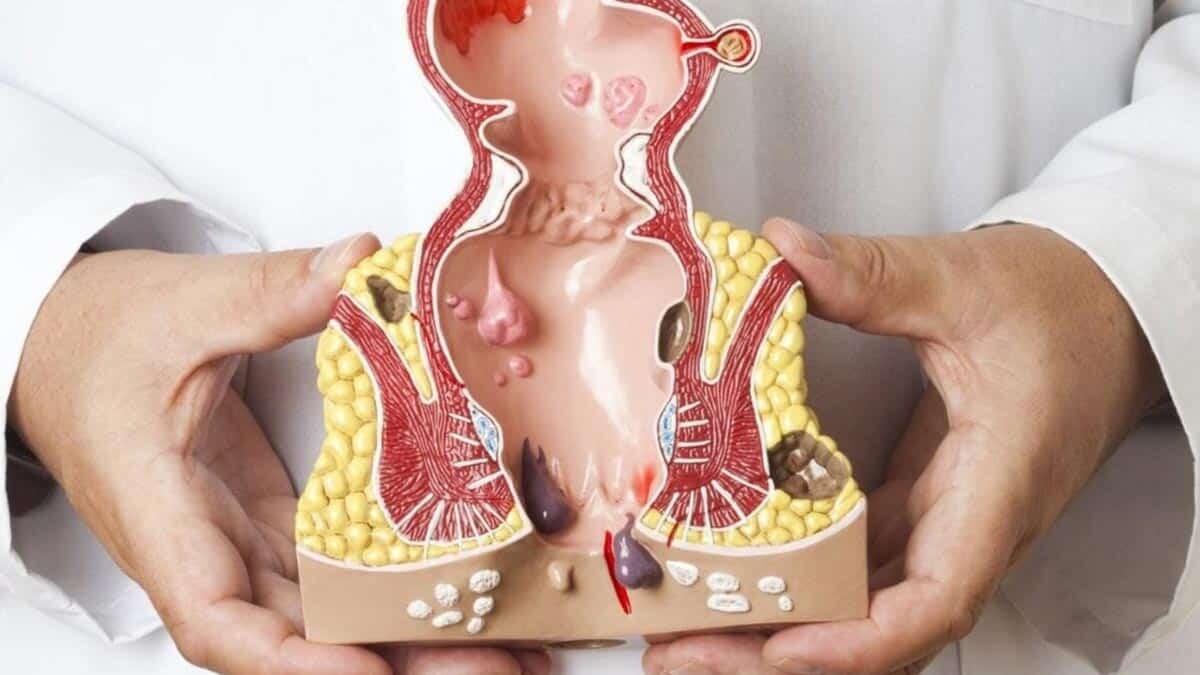 Hemoroid rahatsızlığında artış