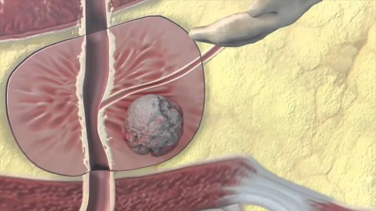 Prostat kanserinde Ac 225 PSMA tedavisi
