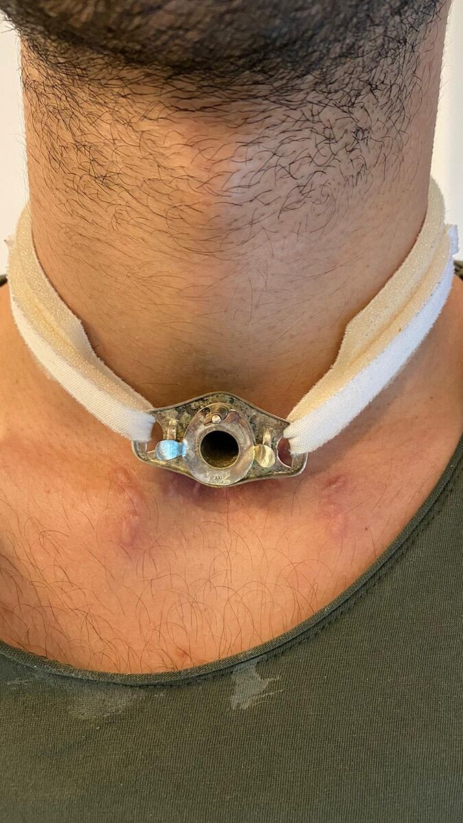 Sesin kısık kalacak denildi aylar sonra konuştu