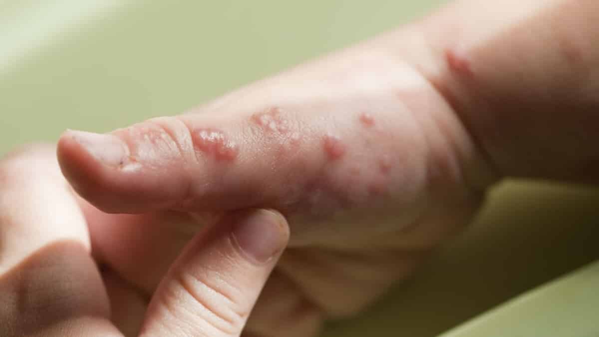 Zona suçiçeği virüsünün tekrar aktive olmasıdır