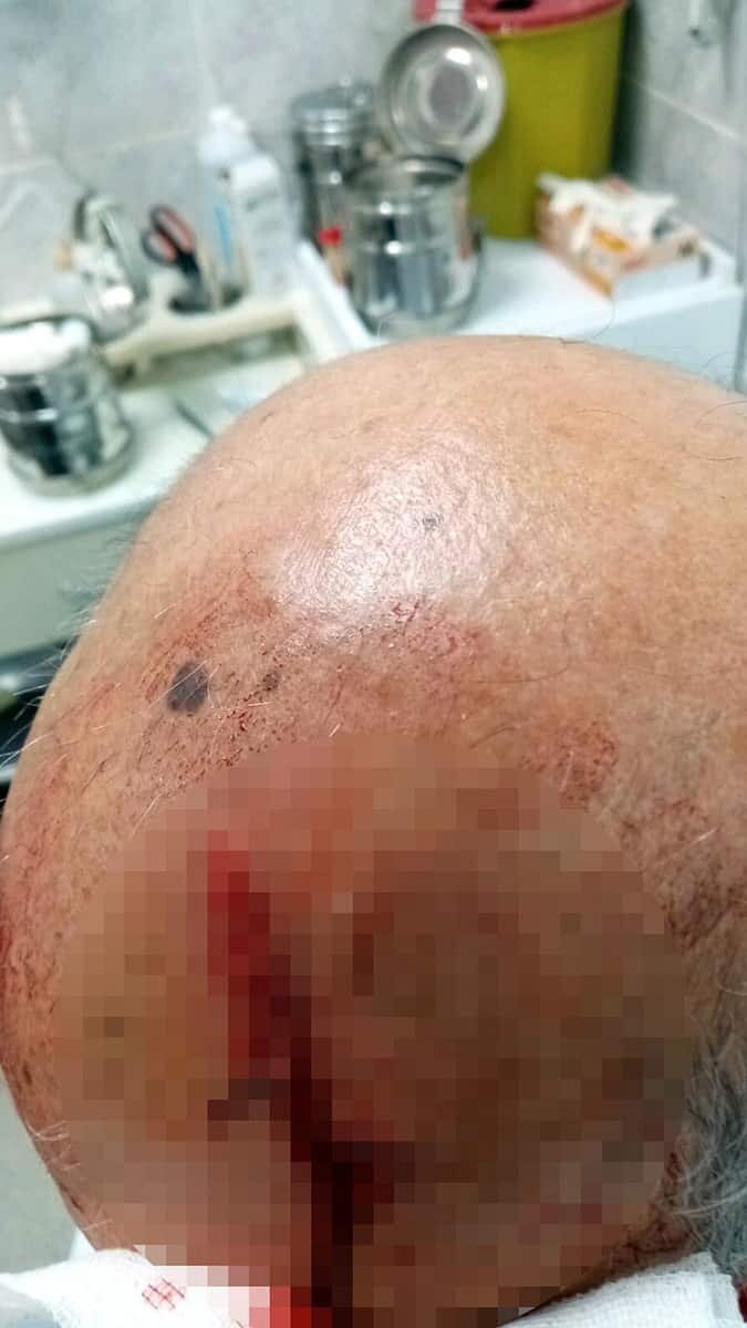 İzmir'de özel bir tıp merkezinin acil servisinde görevli Dr. Hüseyin Nacar Mutlugüleçler, hastayı maskesiz olduğu için ikaz etti kafasına taş yedi.