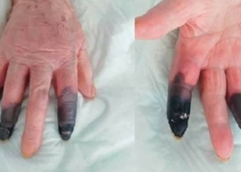 Kangren olan 86 yaşındaki kadın 3 parmağını kaybetti