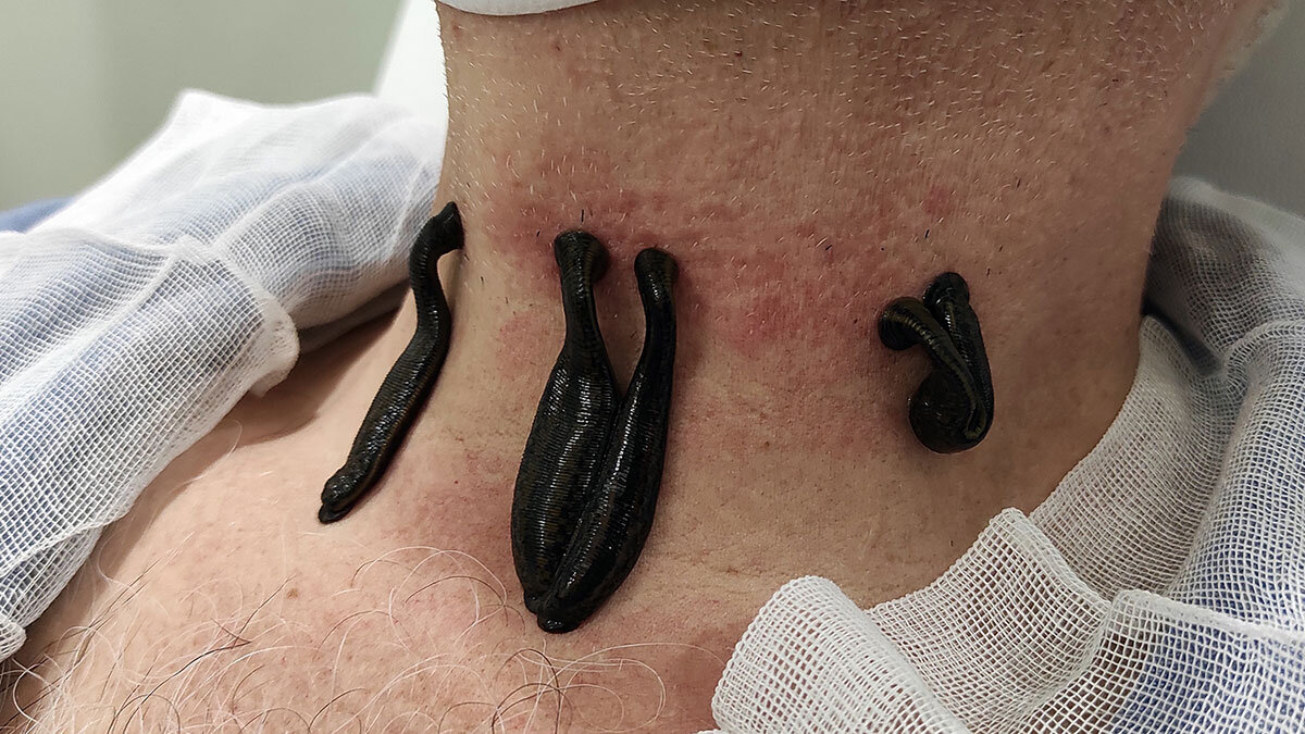 Sülük tedavisi ile özellikle ameliyatlar sonrası kanlanmaya ihtiyaç duyulan bölgelerde kullanılan sülük tedavisi ile hastalar şifa buluyor.