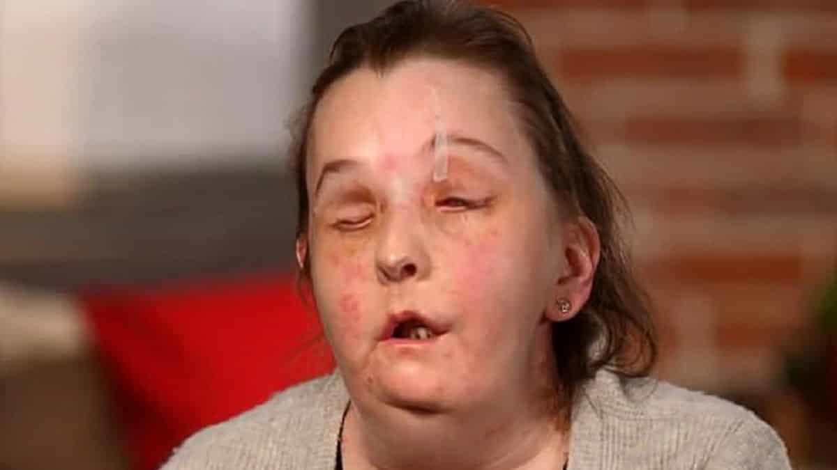 Kocası tarafından yüzüne kimyasal madde dökülen Carmen Tarleton ikinci kez yüz nakli operasyonunun ardından ilk kez basının karşısına çıktı.