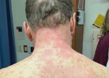 Johnson&Johnson aşısını vurulan kişide yan etki