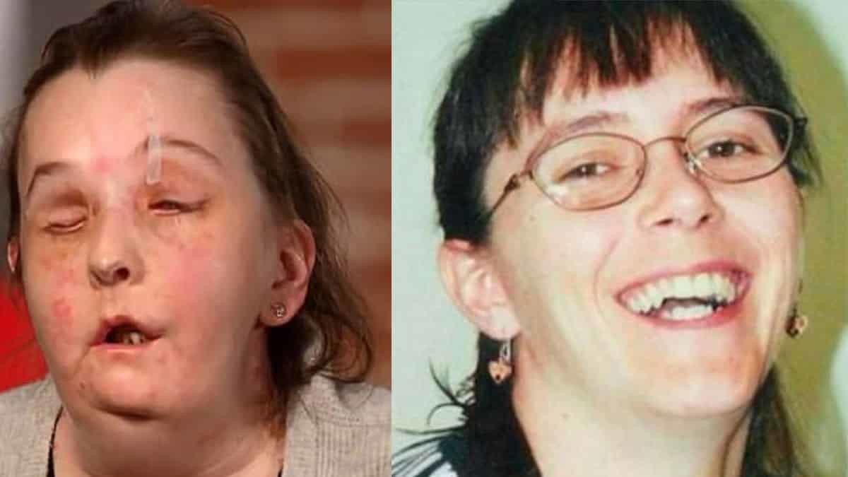 İkinci kez yüz nakli yapılan kadın basın karşısında