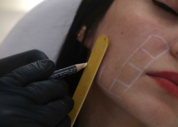 Ameliyatsız yüz germede endopeel yöntem