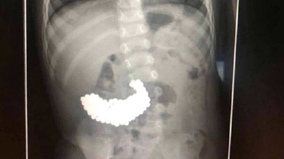 Çocuğun midesinden 209 manyetik top çıkarıldı