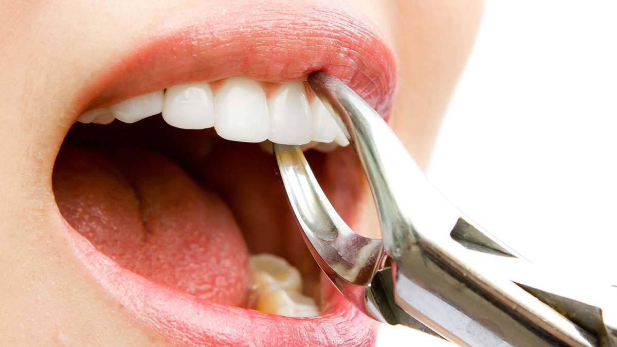 20 yaş dişleri ne zaman çekilmeli?