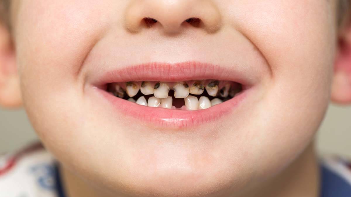 Çocuklarda diş çürükleri neden kaynaklanıyor
