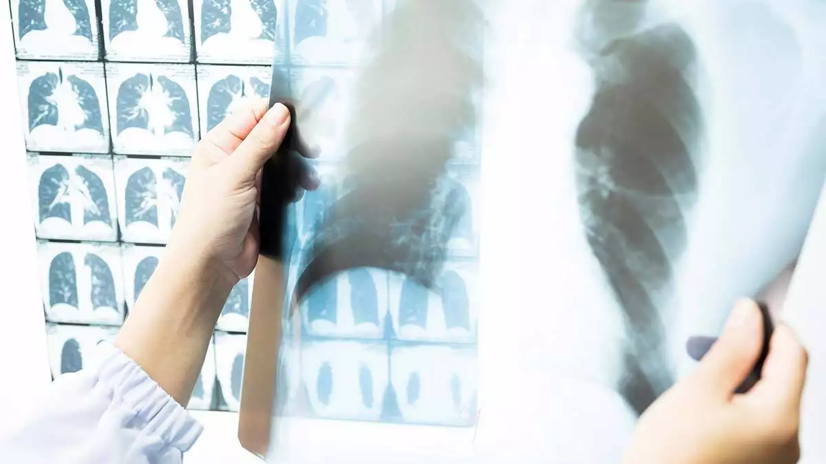 Göğüs hastalıkları uzmanı dr. Öğr. Üyesi seha akduman, akciğer kanserinde tarama yaşının düştüğünü açıkladı.