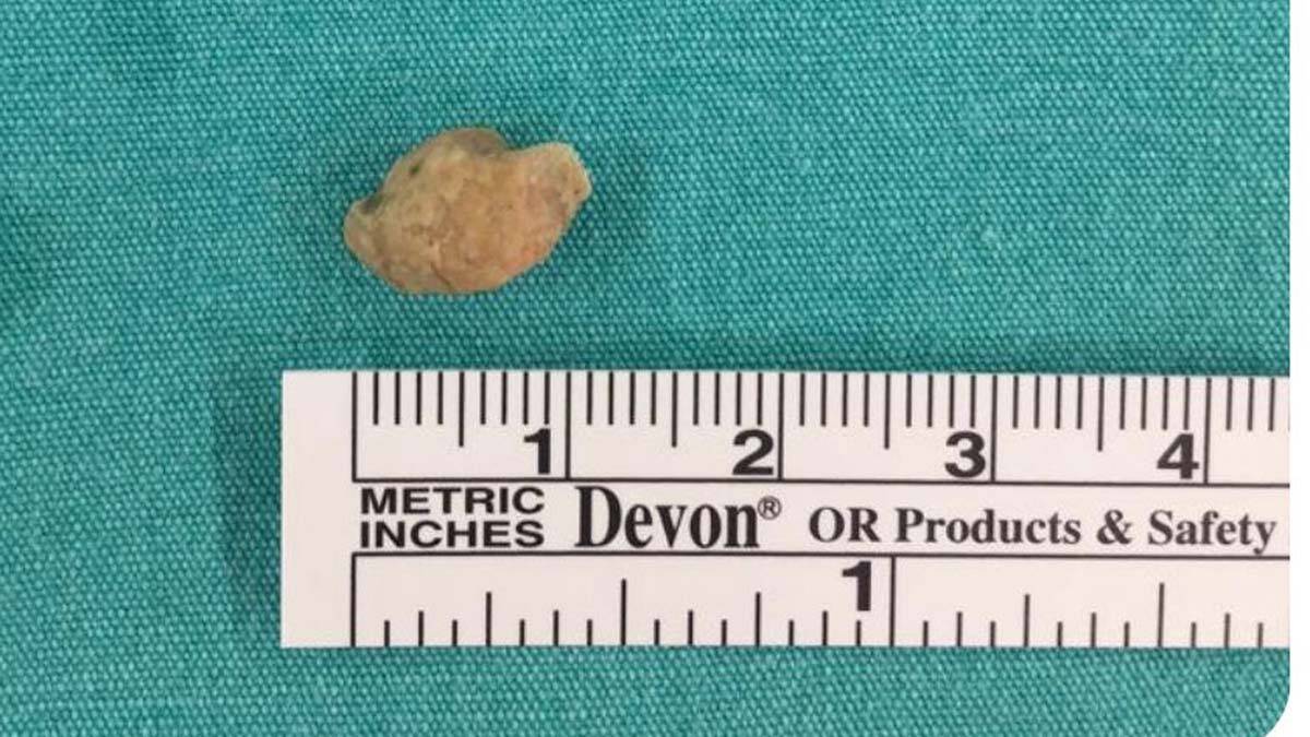 Bademcik iltihabı dediler taş çıktı