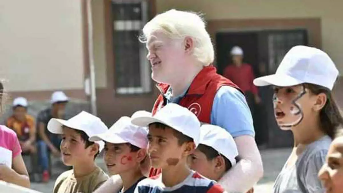 Albino gönüllü genç erol öztamur - albinizmi tanıyalım!