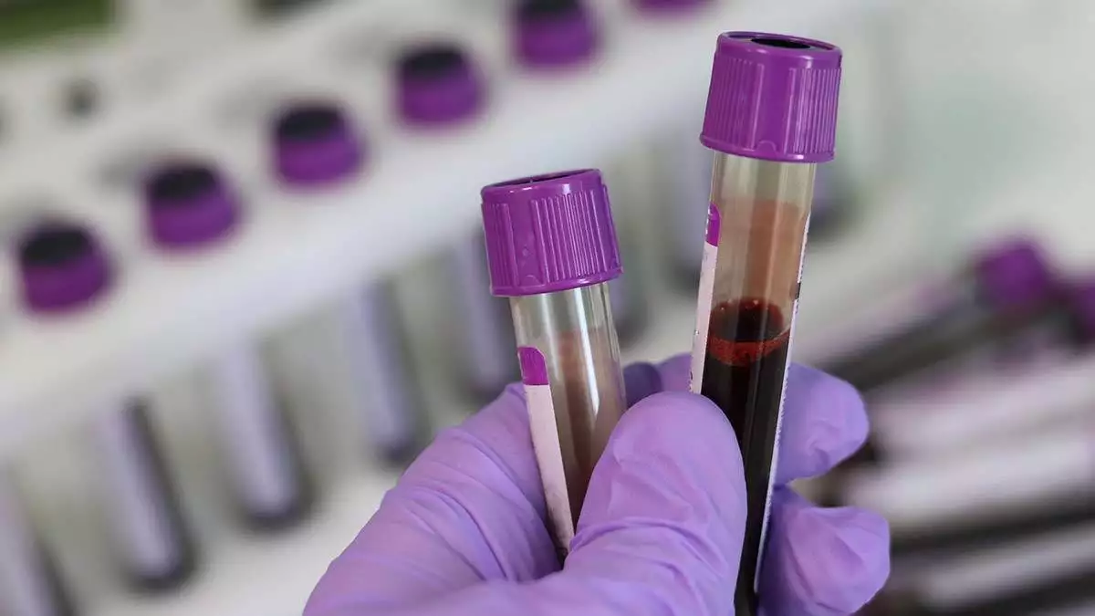 Kanser tespiti yapan yeni kan testi analizi açıklandı