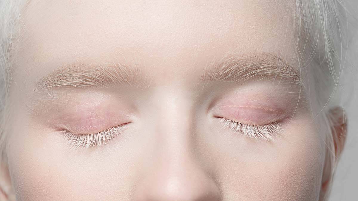 Albinizmi tanıyalım!