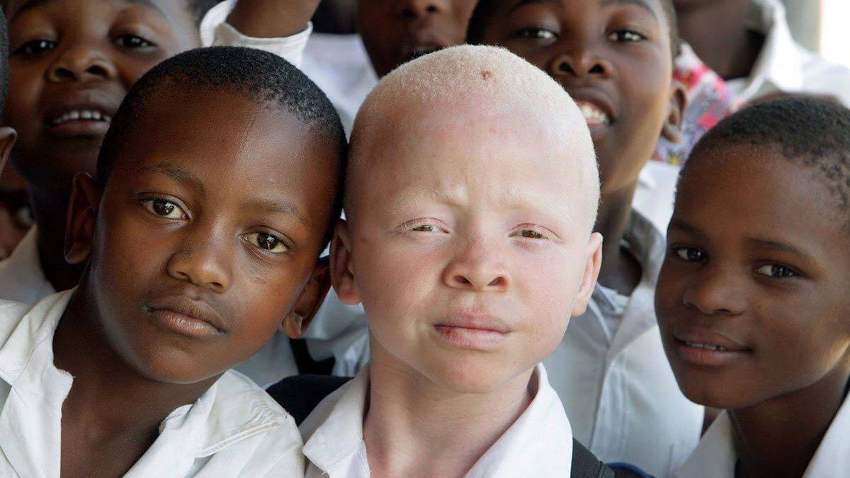 Albinizmi tanıyalım!