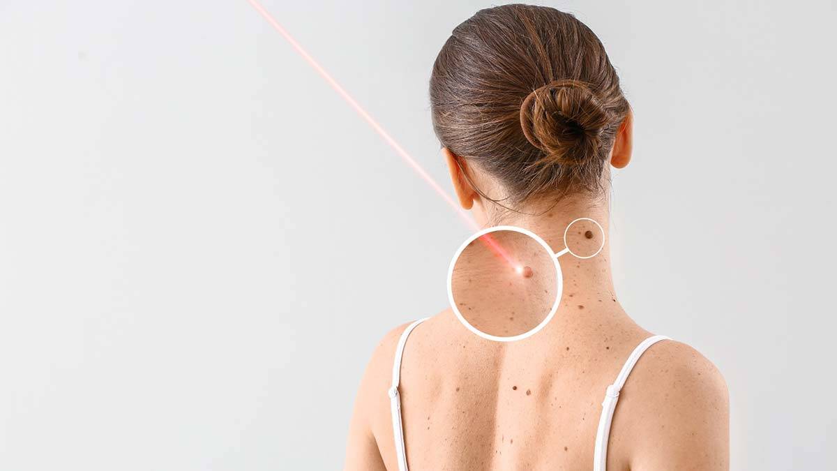 Her siğil kansere neden olmaz