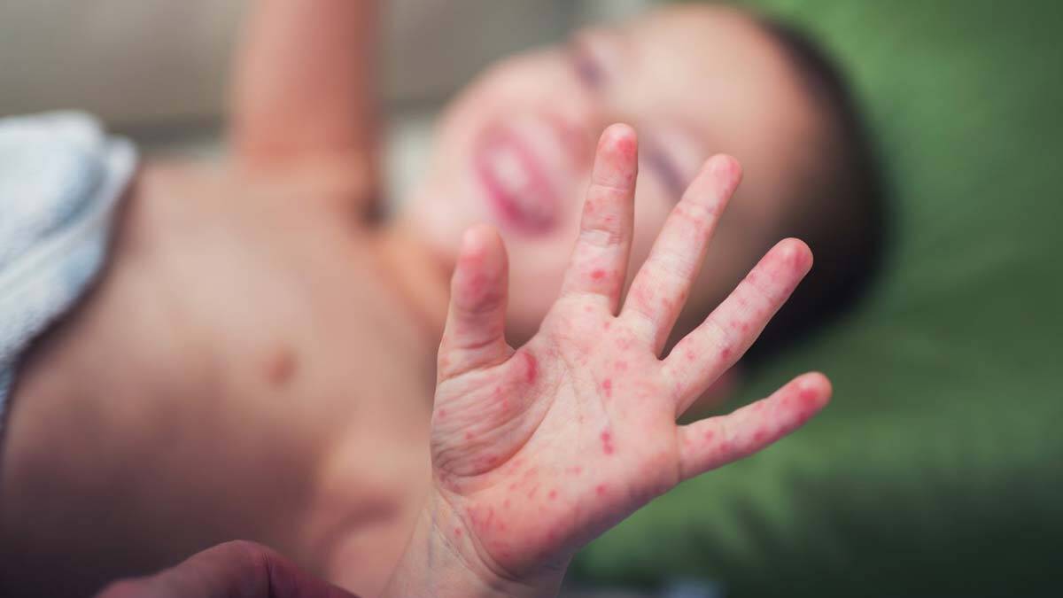 Uzmanından el, ayak, ağız hastalığına karşı uyarı