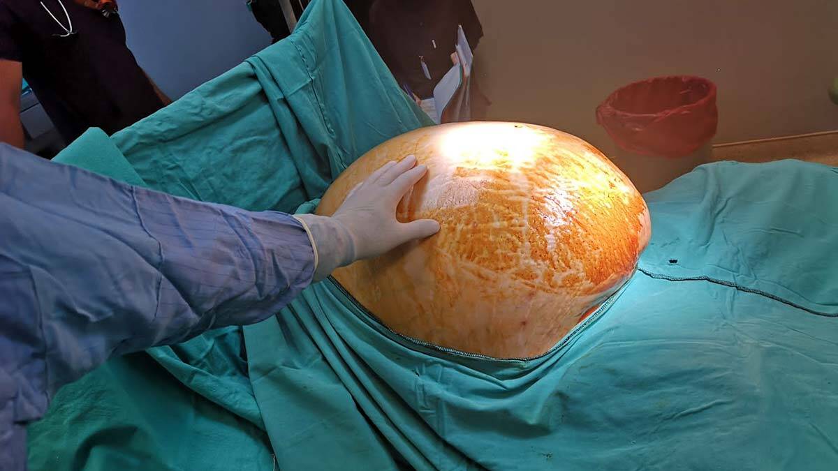 25 yaşındaki kadından 20 kiloluk tümör alındı