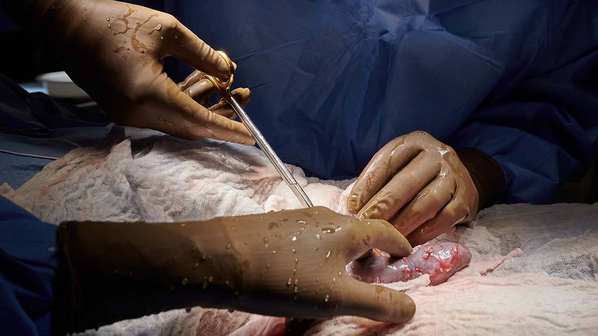 ABD'de domuzdan insana böbrek nakli ABD'de domuzdan insana böbrek nakli