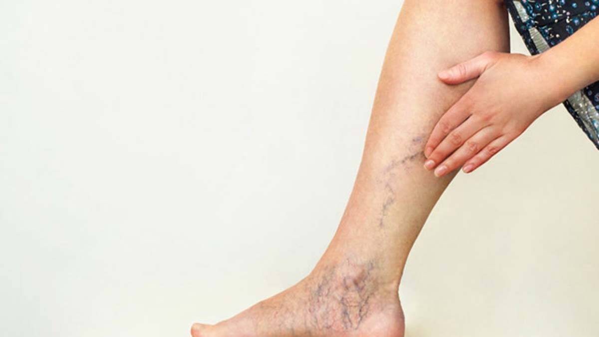 Varis sorununa kapalı ameliyat ile çözüm