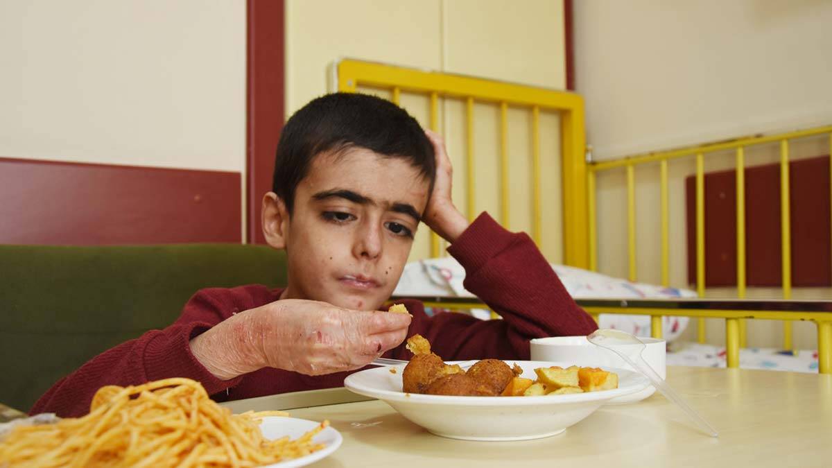 Kütahya Sağlık Bilimleri Üniversitesi (KSBÜ) Tıp Fakültesi'ne gelerek tedavi edilen 6 kelebek hastası, ilk kez katı yiyecek yedi.