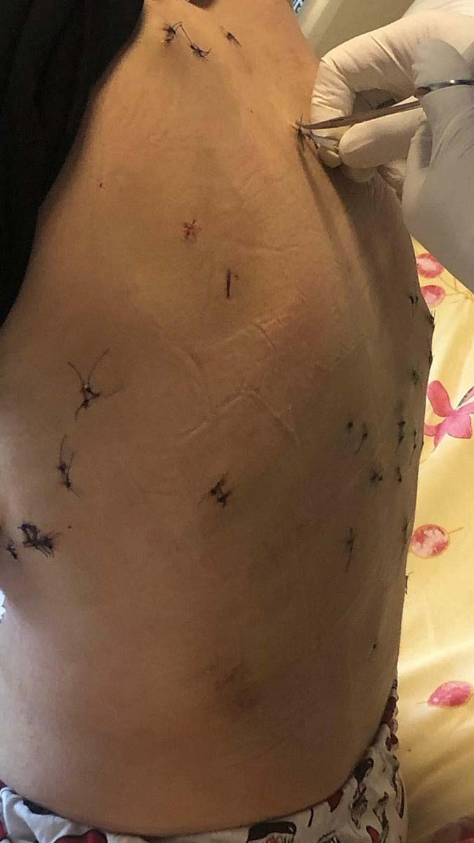 Barışma teklifini kabul etmeyen Aycan Kıncı'yı 38 bıçak darbesiyle yaralayan Burak Kıncı'ya verilen 18 yıl hapis cezası İzmir Bölge Adliye Mahkemesi 4'üncü Ceza Dairesi, tarafından onandı.