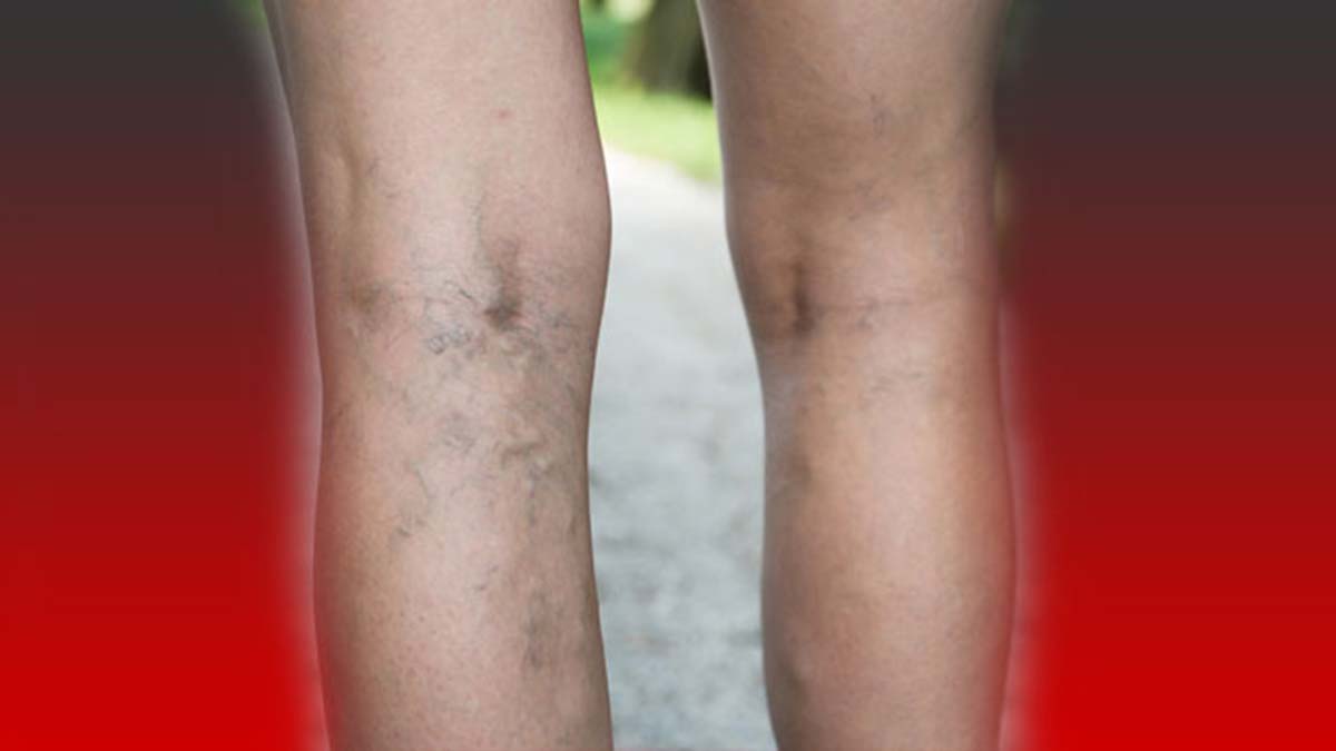 Varis tedavisi için en uygun ay kış ayları