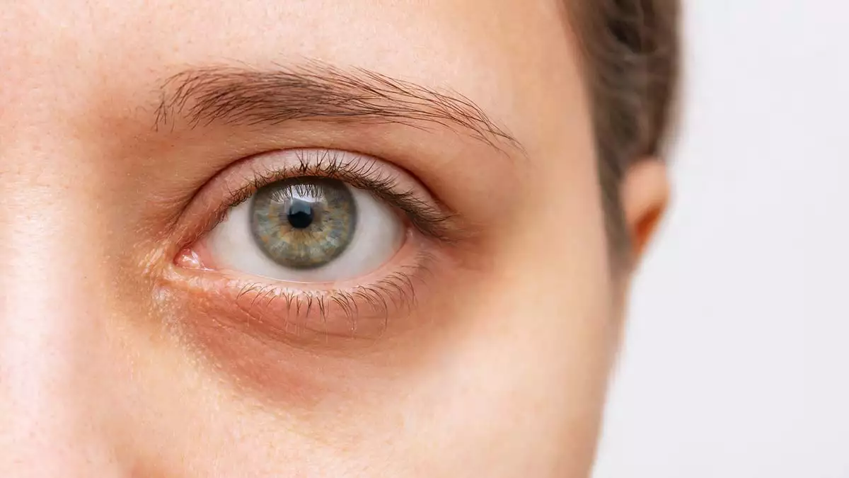 Göz altı morlukları sebepleri ve tedavi yöntemi