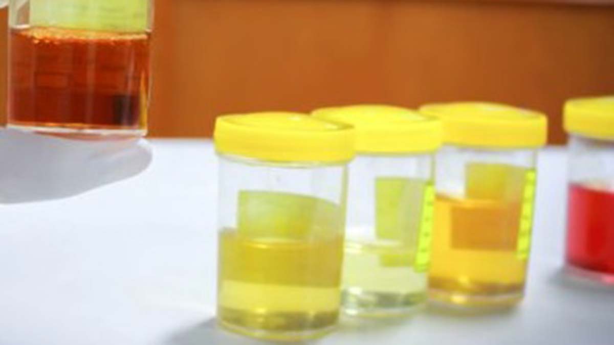 Hangi idrar rengi hangi hastalığın habercisi?