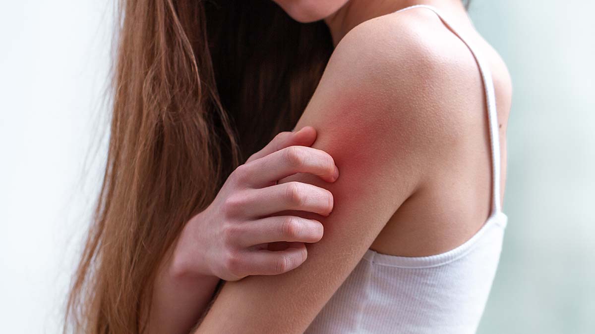 Soğuk alerjisi kaşıntı sebebi olabilir