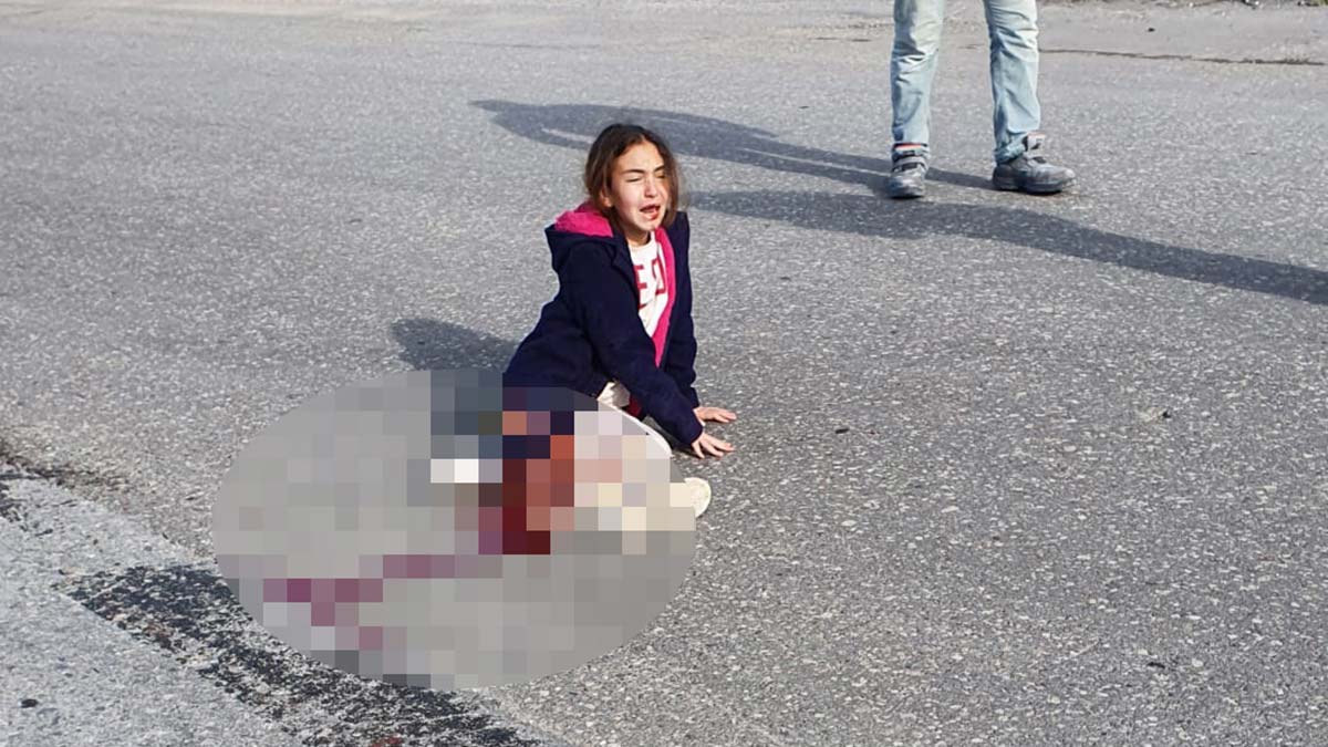 Antalya'nın Serik ilçesinde, sahipsiz köpeklerden kaçarken kamyonun altında kalması sonucu ağır yaralanıp, sağ bacağı diz üstünden kesilen Mahra'nın sol beyin lobunda ağır hasar var.