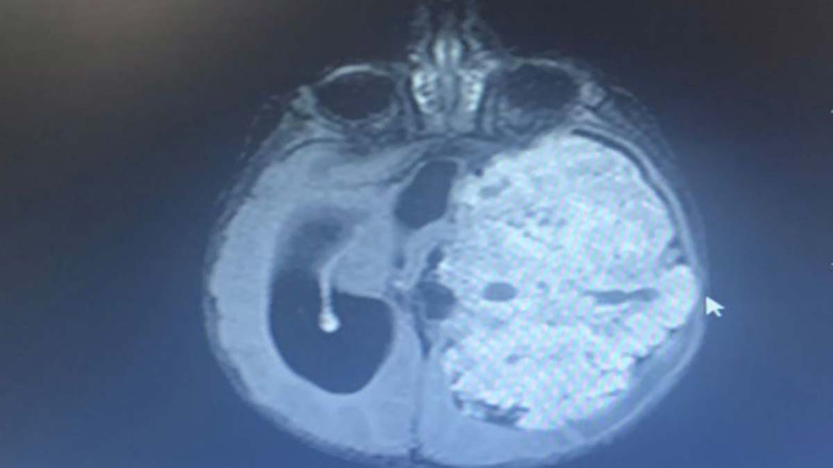 Asaf bebeğin beynini saran tümör temizlendi