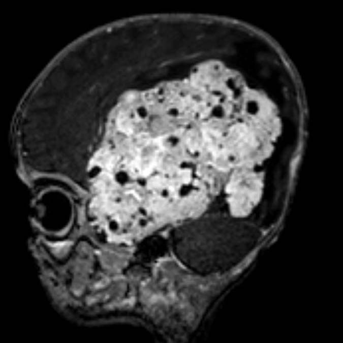 Ankara'da 3 aylık Mehmet Asaf Kılıç bebeğin beynini saran tümör, yaklaşık 9 saat süren ameliyatla temizlendi.