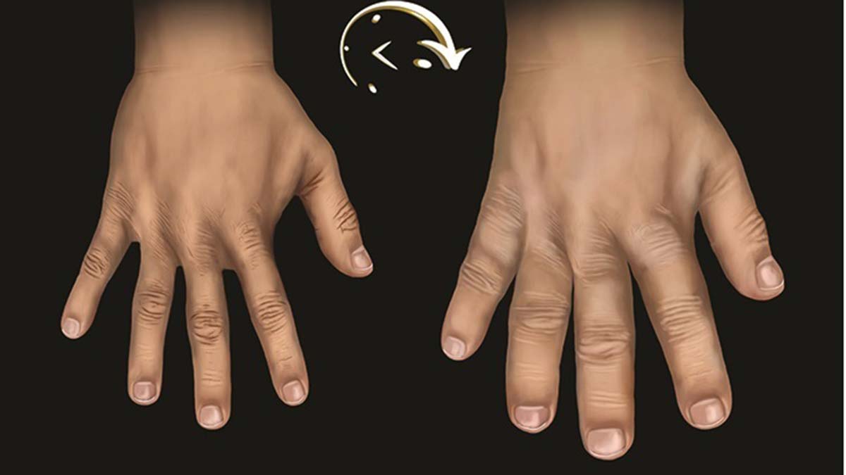 Akromegali'de erken tanı için farkındalık şart