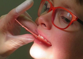 Diş tedavilerinde rejeneratif endodontik yöntemi
