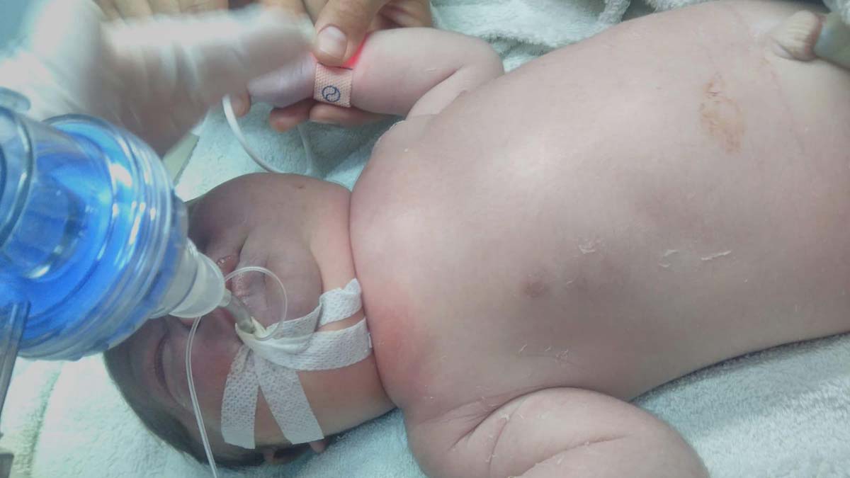 Doğumda bebeğin köprücüğünün kırıldığı iddiası