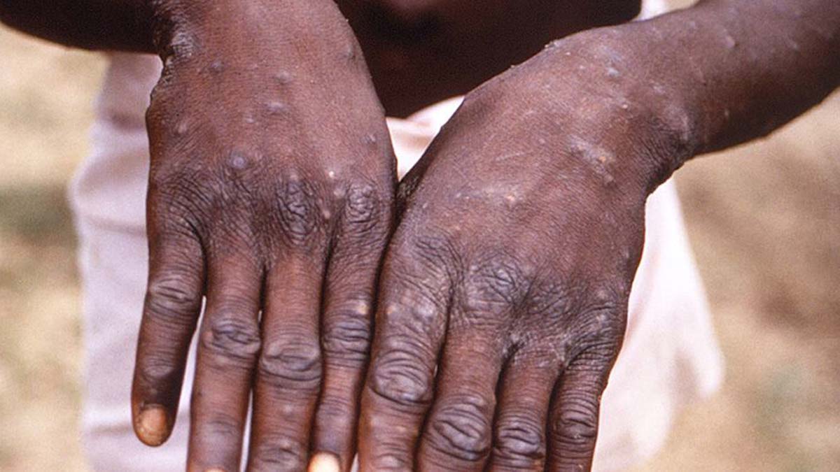 Dünya çapında 80 maymun çiçeği vakası var