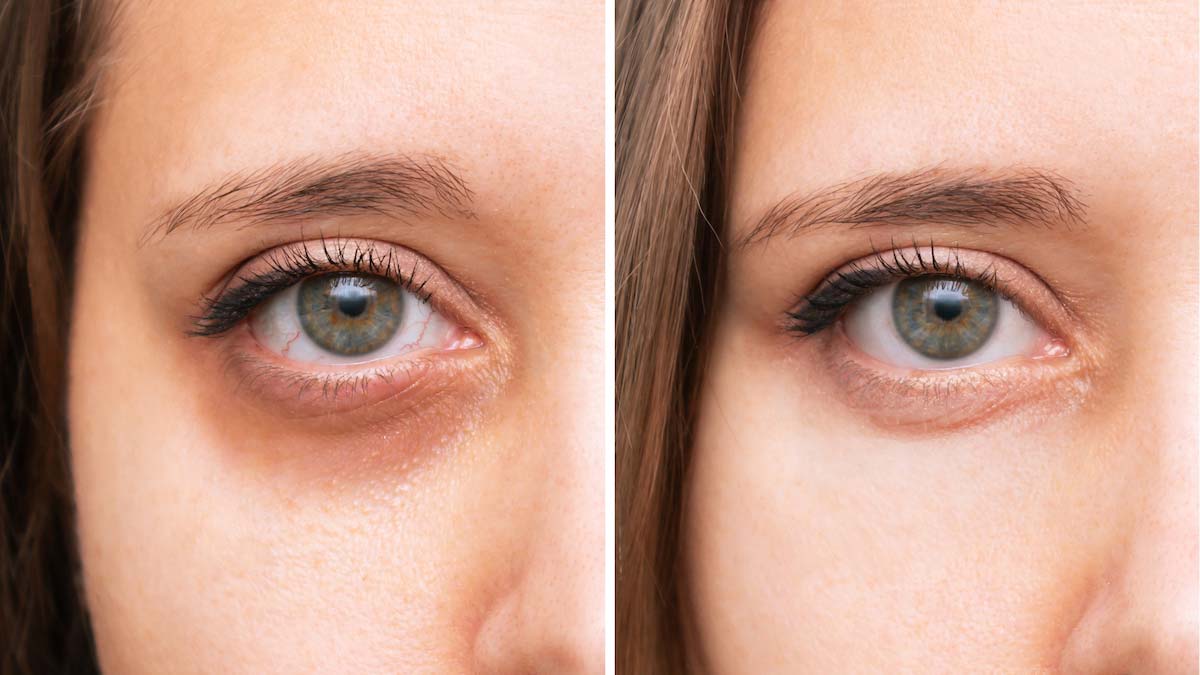 Gözaltındaki mor halkalara dikkat