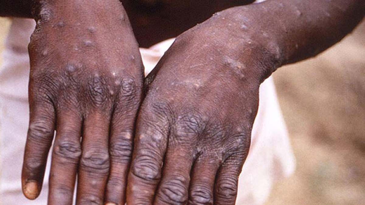 Maymun çiçeği çocuklarda daha ciddi seyredebilir