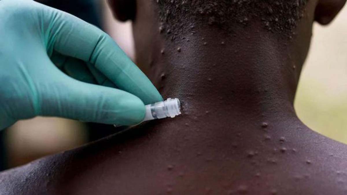 Maymun çiçeğinde karantina 28 gün sürebilir