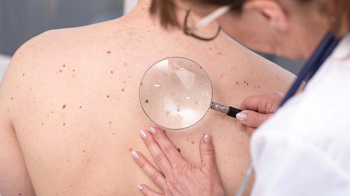 Deri kanserinden nasıl korunuruz?