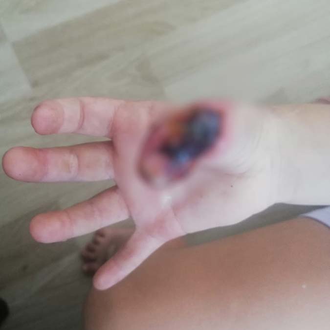 Kadıköy'de 6 yaşındaki küçük Elif MR'da yandı, Kızlarının sağlığına kavuşması için çaba harcayan aile hastaneden ve olayın sorumlularından şikayetçi oldu.