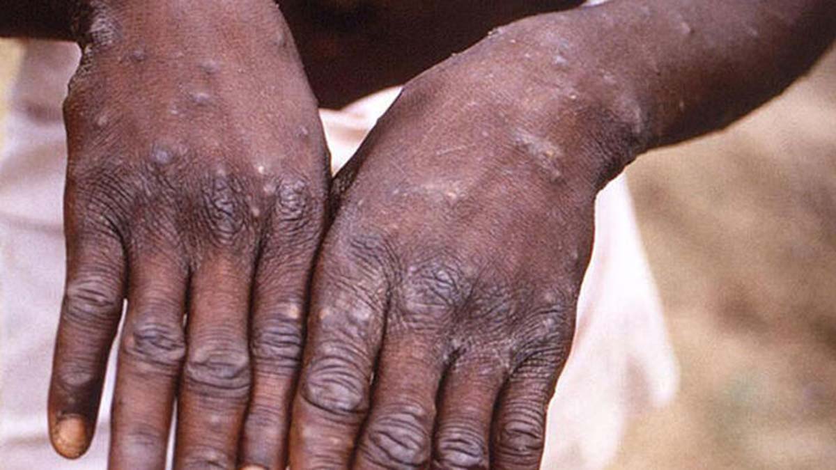 Maymun çiçeğinden korunmak için maske takın