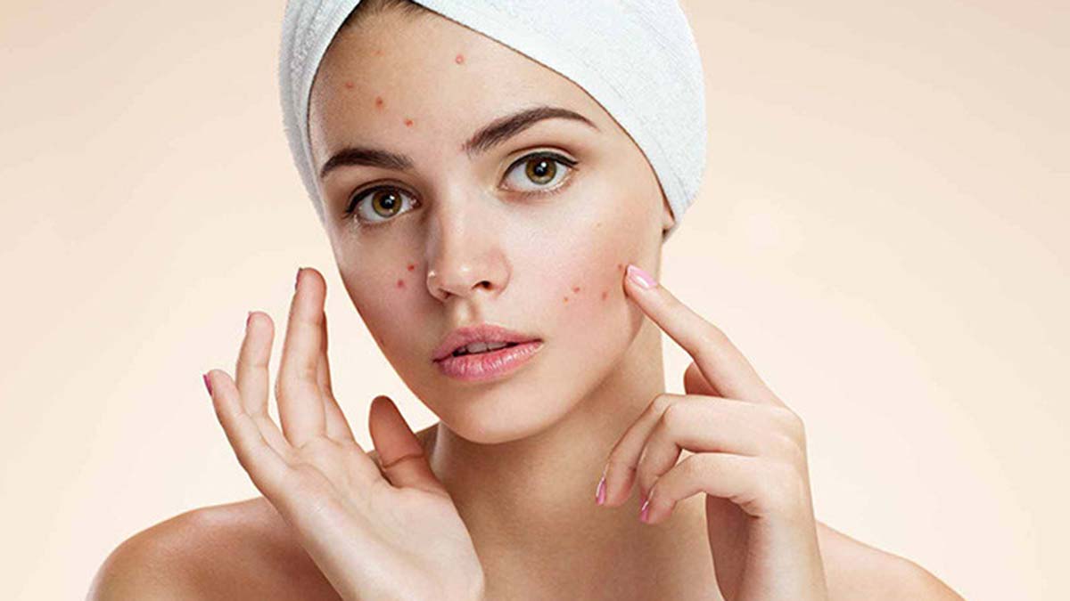 Akne tedavisine lekeler oluşmadan başlanmalı