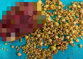 Safra kesesinden 1284 adet taş çıktı